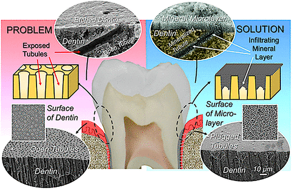 Ученые научились защищать зубы, лишившиеся эмали.